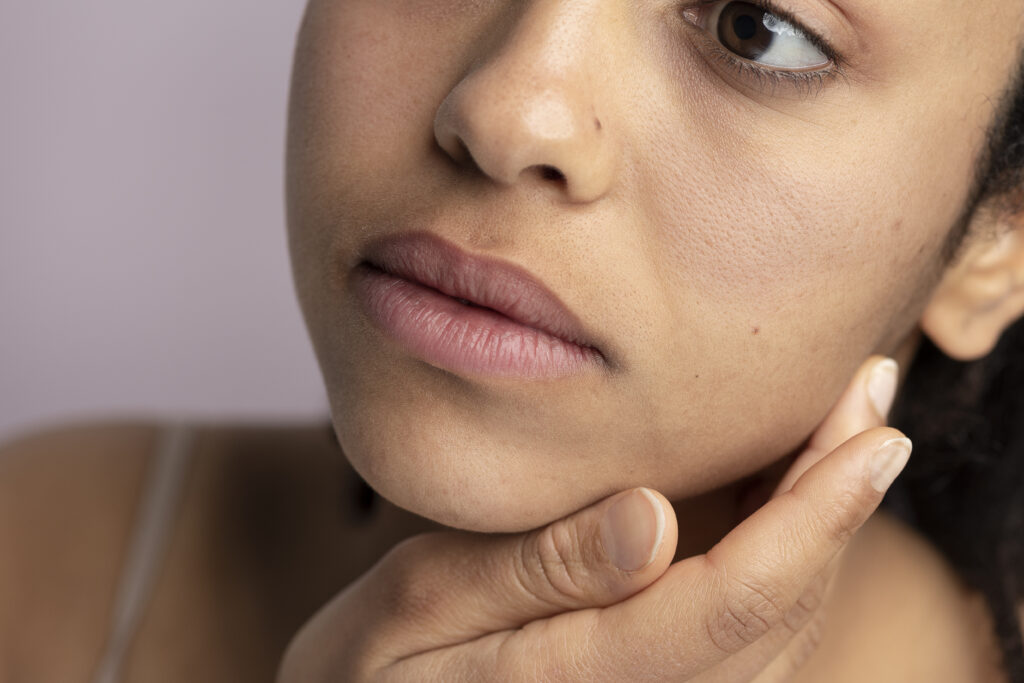 Freepik imagem: mulher jovem que está tratando melasma.